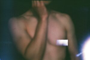 Photo dislocated shoulder